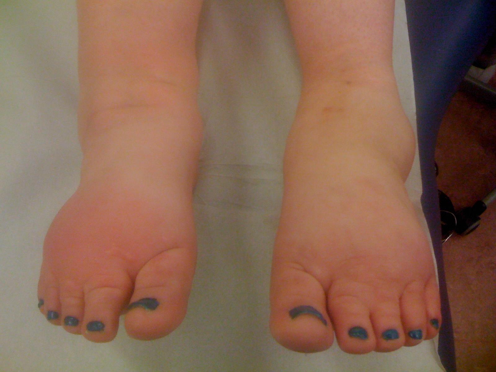 Lymphedema of the feet